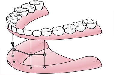 Mini Implants – Weiss Dentistry, Cockeysville