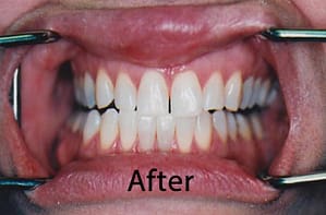 Hunt Valley Teeth Whitening, Teeth Whitening Cockeysville