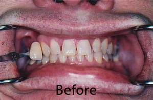 before image teeth