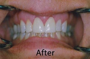 Hunt Valley Veneers, Cockeysville Dental Veneers