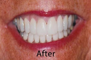 Hunt Valley Veneers, Cockeysville Dental Veneers