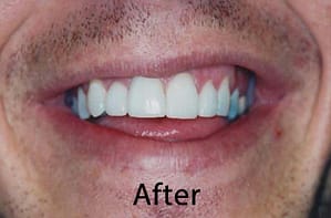 Hunt Valley Veneers, Cockeysville Dental Veneers