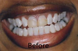 Hunt Valley Veneers, Cockeysville Dental Veneers