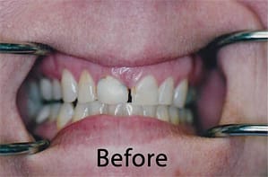 Hunt Valley Veneers, Cockeysville Dental Veneers