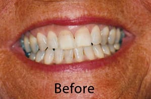 Hunt Valley Veneers, Cockeysville Dental Veneers