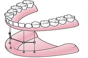 Mini Dental Implants Near Me