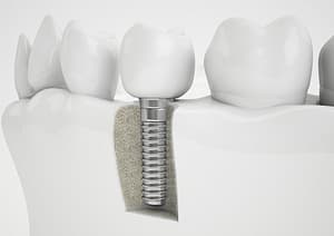 Standard Dental Implants