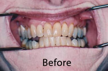 Before dental procedure