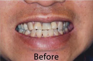 Dental Veneers Near Me
