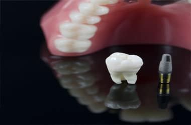 Preparation for Dentures