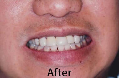 Dental Veneers Near Me1