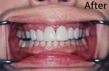 Dental Veneers Near Me4