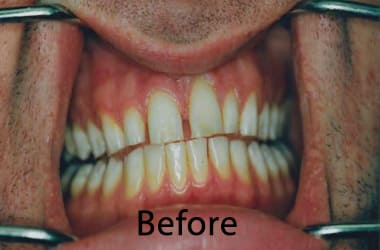 Dental Veneers Near Me5